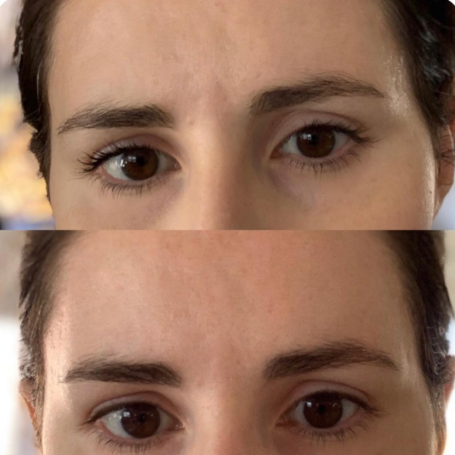 Patchs nocturnes liftants en silicone   réutilisables & 100% naturels