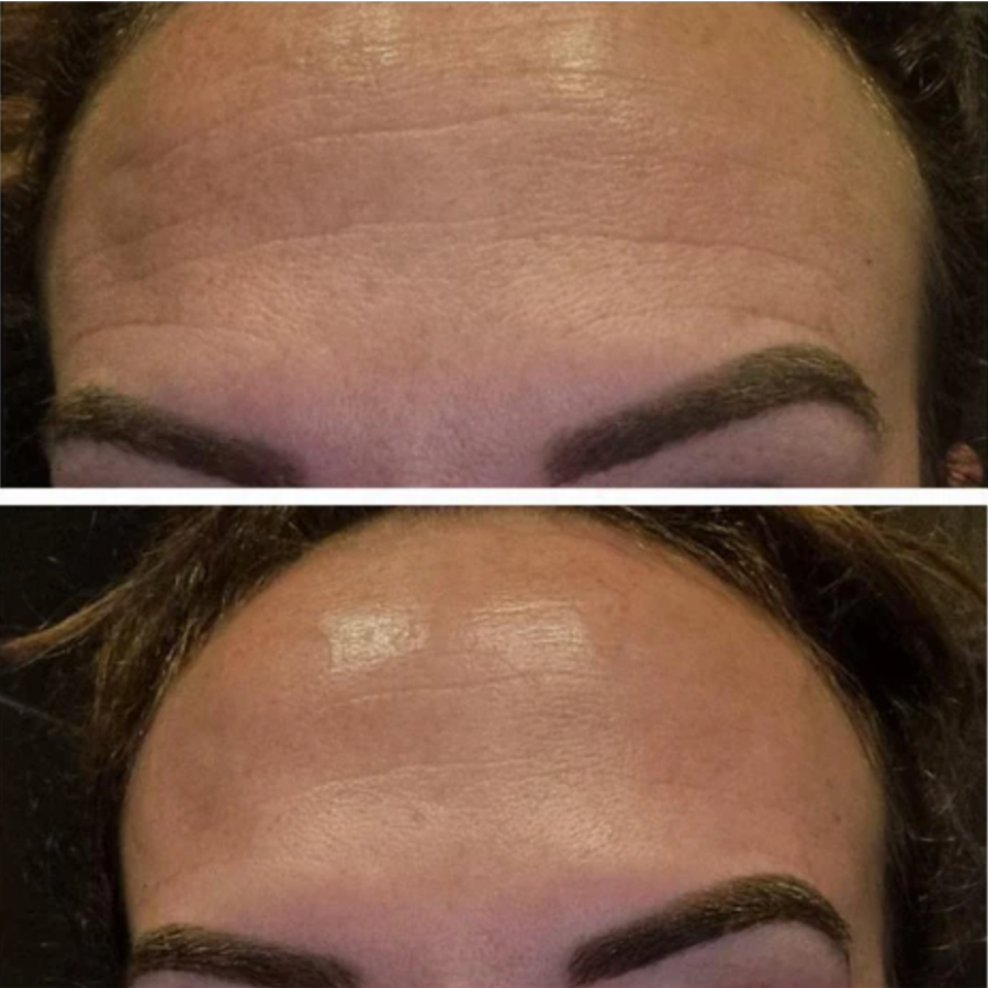 Patchs nocturnes liftants en silicone   réutilisables & 100% naturels
